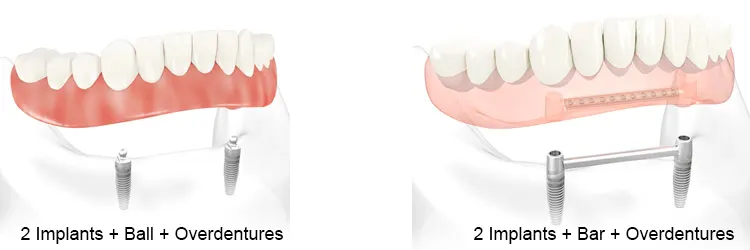Implant Overdenture