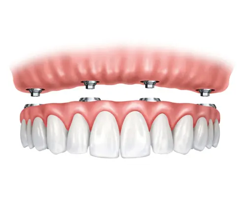 Implants Fixed Bridge