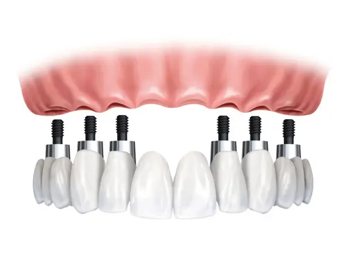 Implants Fixed Bridge