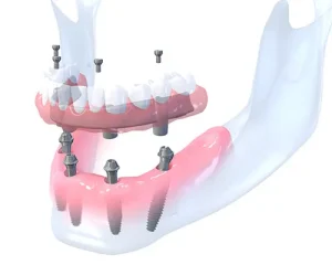All on 4 dental implant