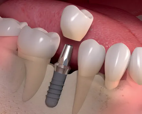 Dental Implant