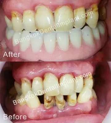 Dental Implant