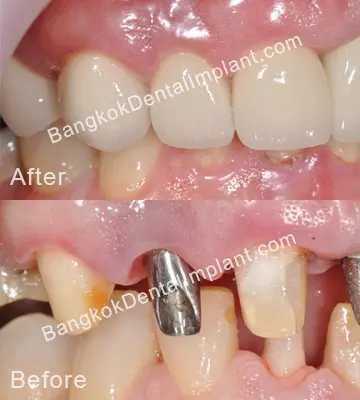 Dental Implant